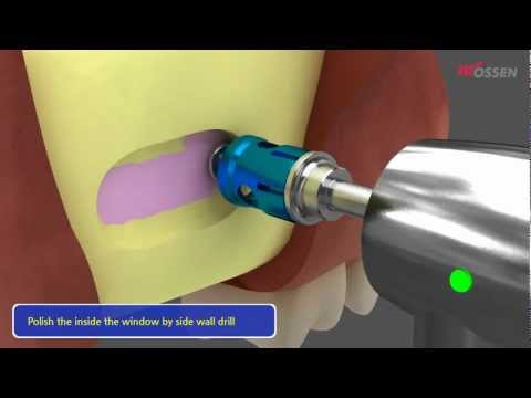 LAS KİT (Lateral Approach - Sinus KIT)